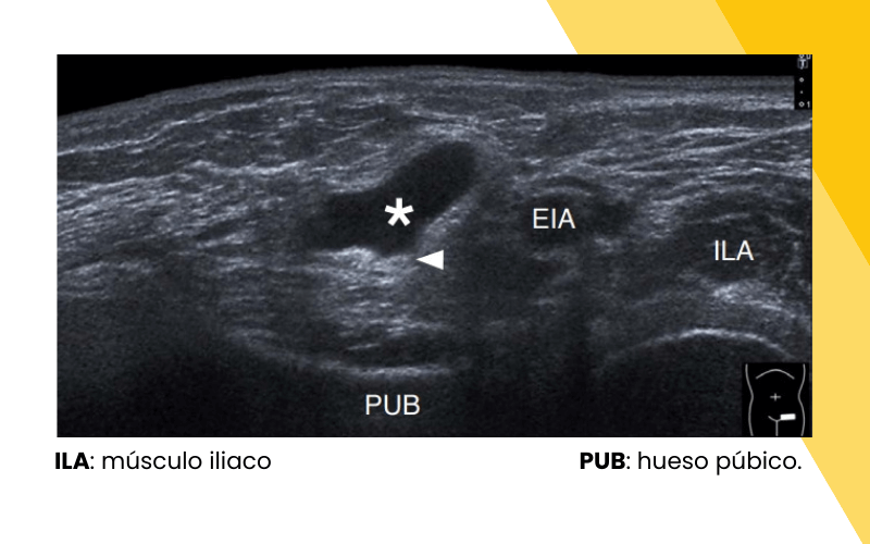 8. Hernia inguinal indirecta ecografia tempo formacion.png